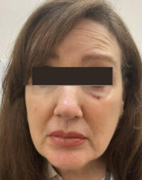 Basal Cell Carcinoma