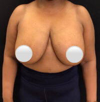 Breast Implant Removal