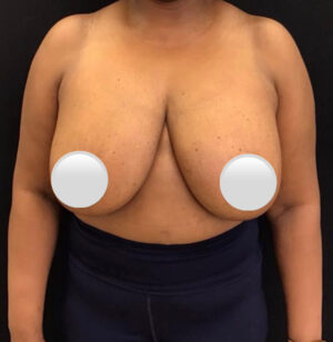 Breast Implant Removal