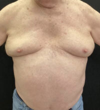 Gynecomastia