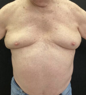 Gynecomastia