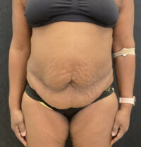 Panniculectomy