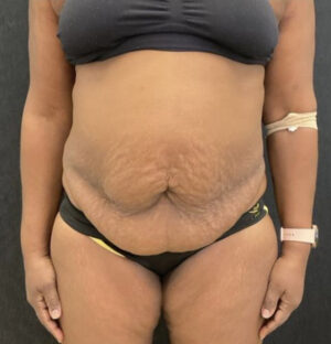 Panniculectomy