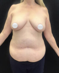 Tummy Tuck