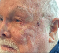 Basal Cell Carcinoma