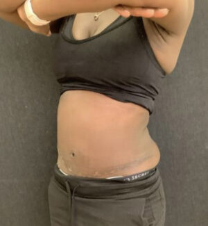 Panniculectomy