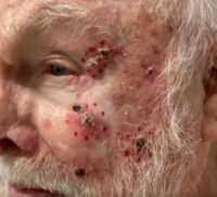 Basal Cell Carcinoma