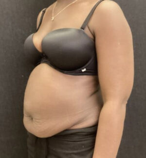 Panniculectomy