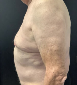 Gynecomastia