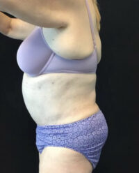 Tummy Tuck