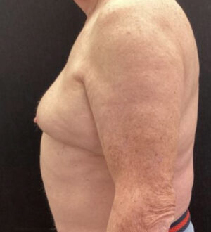 Gynecomastia