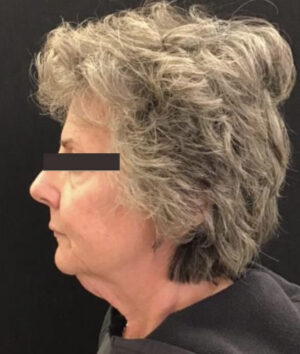 Nouveaulift