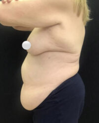 Tummy Tuck