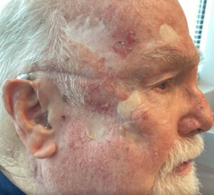 Basal Cell Carcinoma