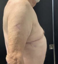 Gynecomastia