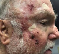 Basal Cell Carcinoma