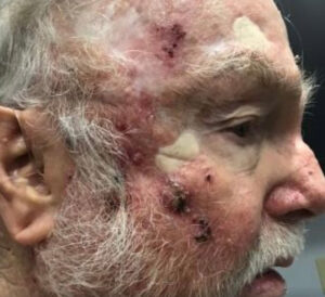 Basal Cell Carcinoma