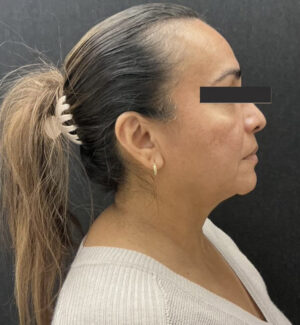 Facetite