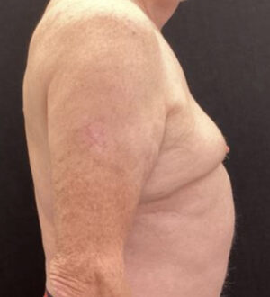 Gynecomastia