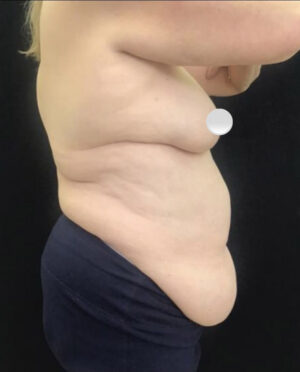 Tummy Tuck
