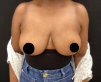 Breast Implant Removal