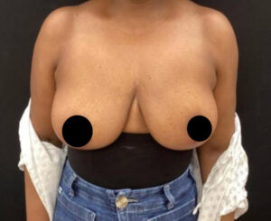 Breast Implant Removal