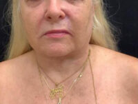 Neck Lift