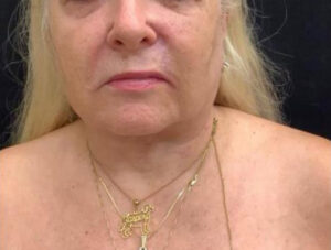 Neck Lift