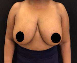 Breast Implant Removal