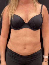 Liposuction
