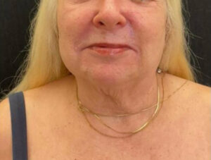 Neck Lift
