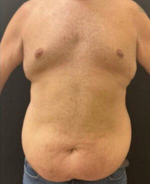 Tummy Tuck