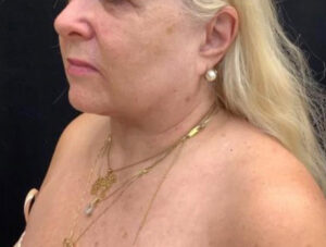Neck Lift
