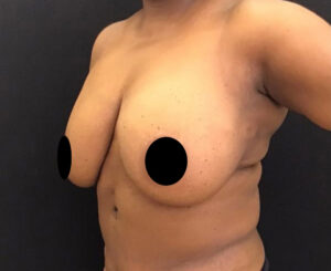 Breast Implant Removal