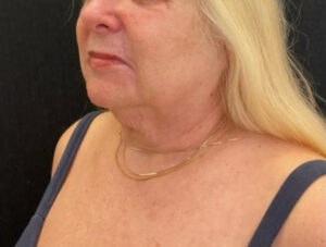 Neck Lift