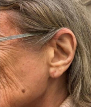 Ear Surgery