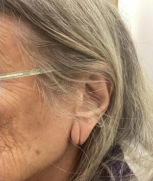 Ear Surgery