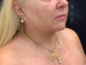 Neck Lift