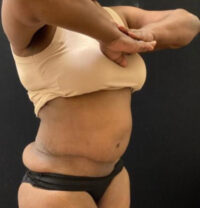 Panniculectomy