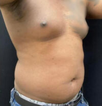 Liposuction
