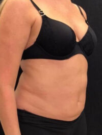 Liposuction