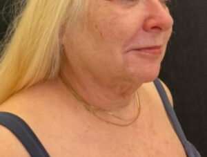 Neck Lift
