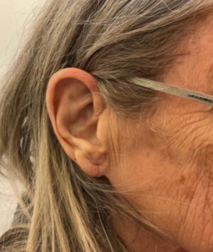 Ear Surgery