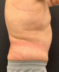 Tummy Tuck