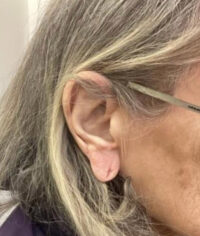 Ear Surgery