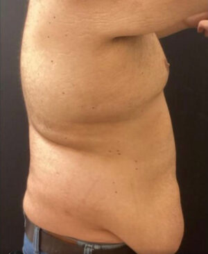 Tummy Tuck